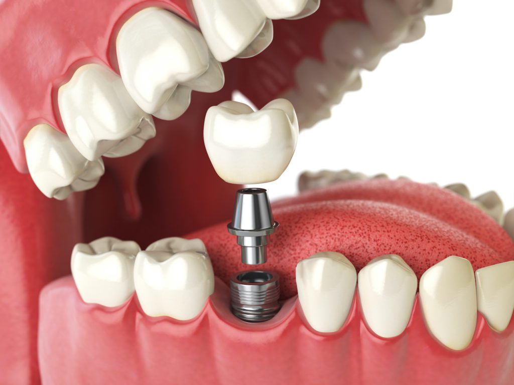 dental implants in timonium, maryland