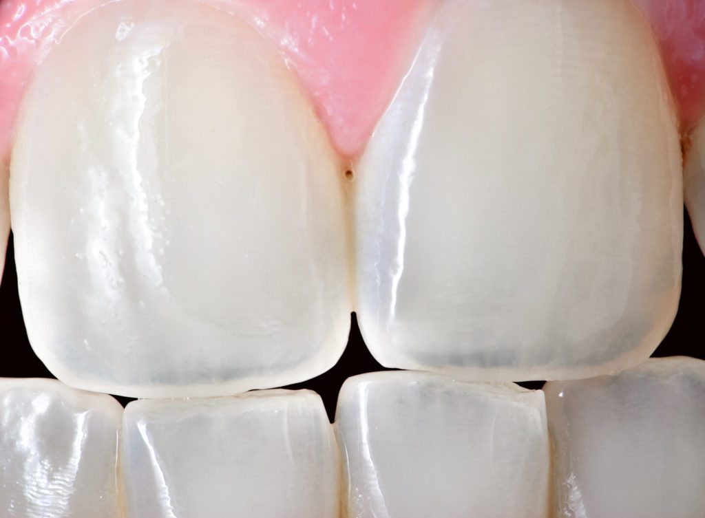 Treat a Damaged Tooth in Owings Mills, Maryland