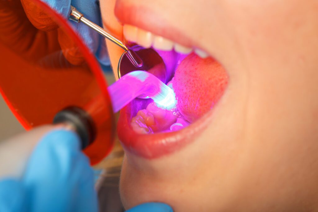 Answering Dental Bonding Questions