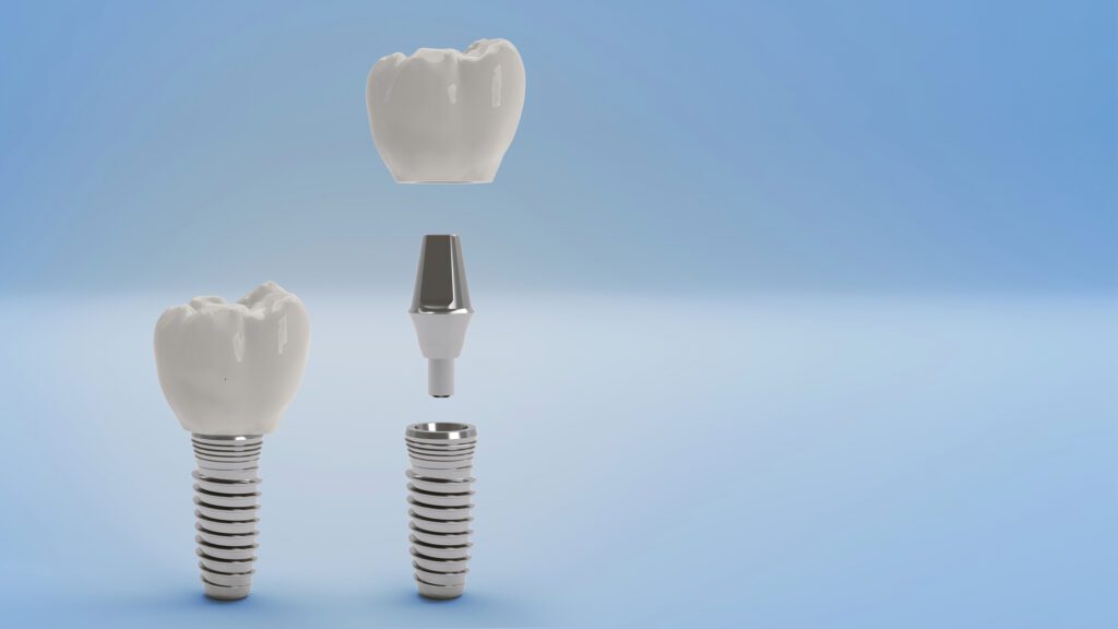 Dental Implant FAQ in Baltimore, MD