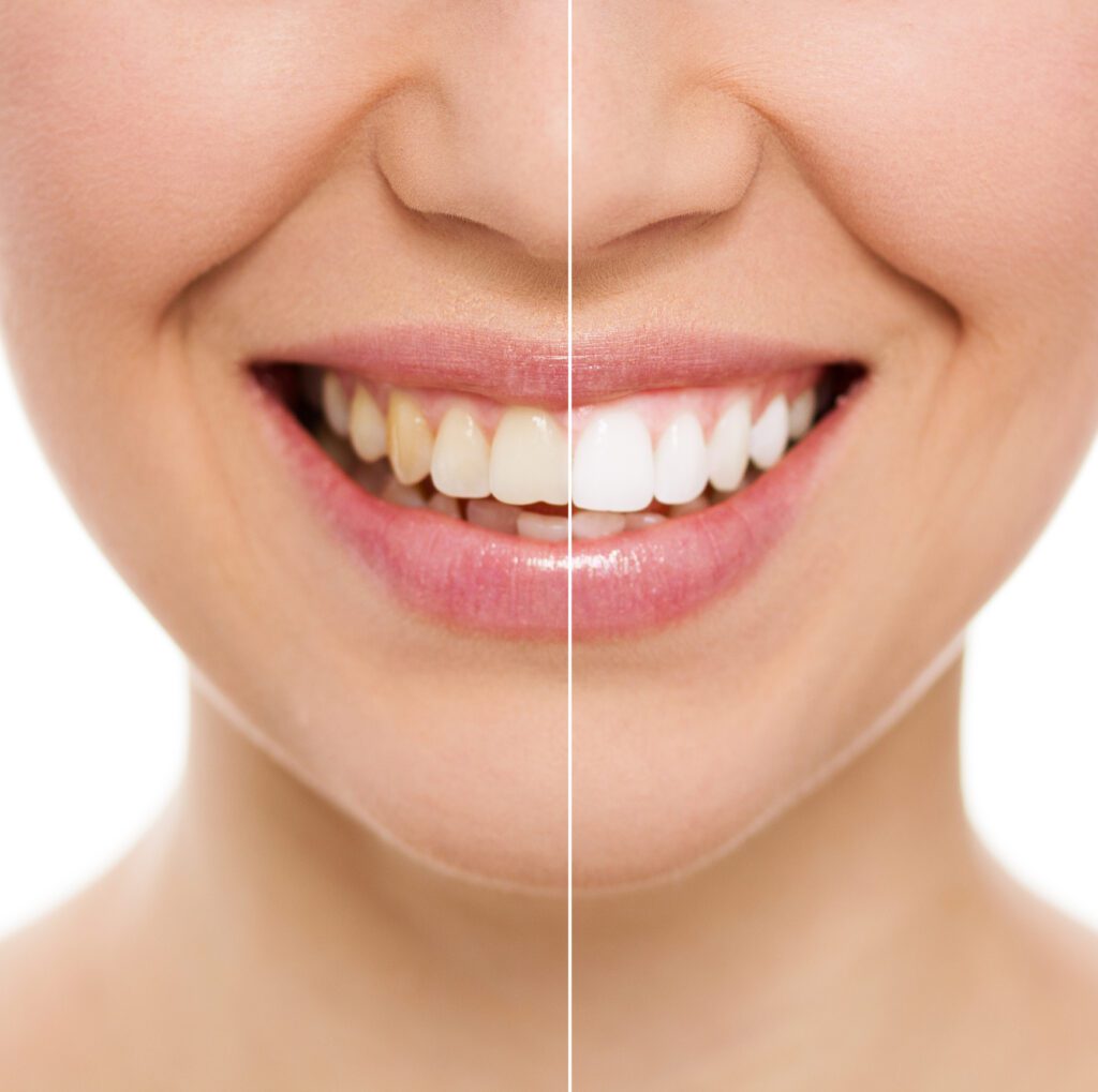Teeth Whitening in Baltimore, MD