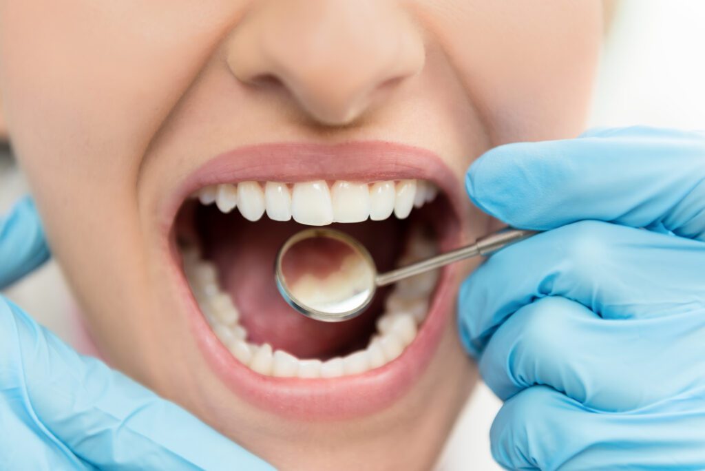 Dental Cavities in Baltimore MD