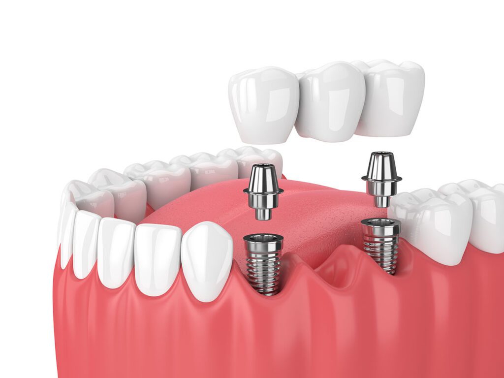Replacement Options for Missing Teeth