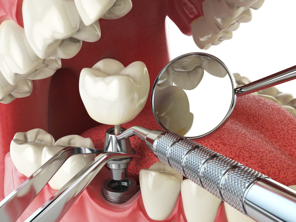 DENTAL IMPLANTS in BALTIMORE can be a great option to restore missing teeth