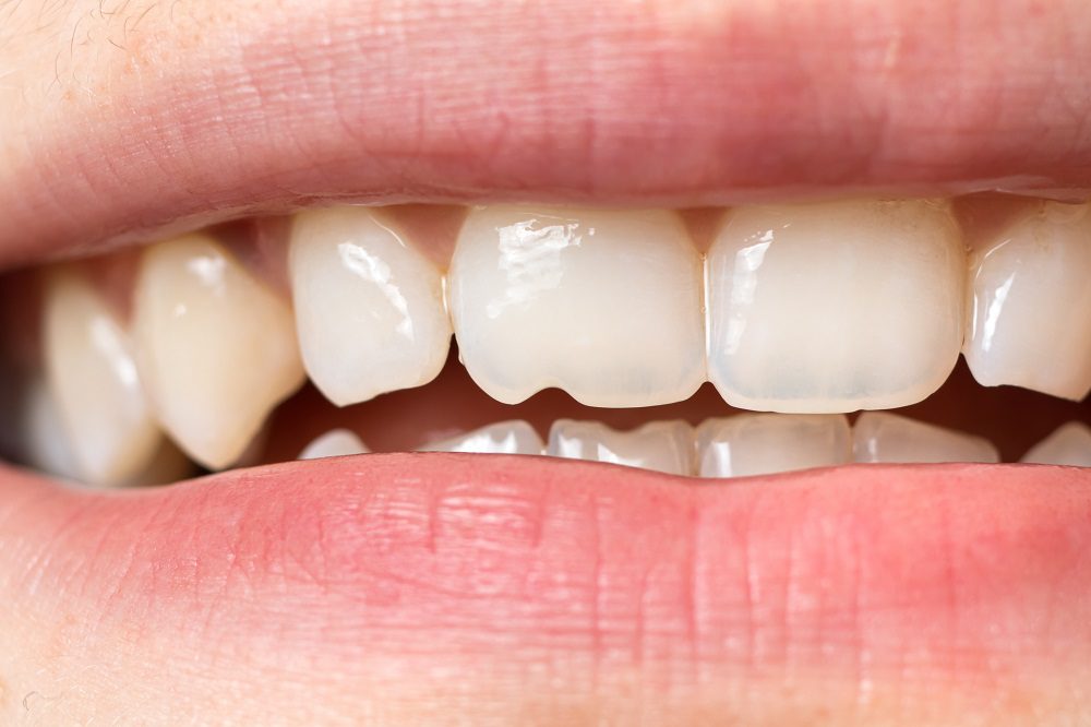 Tooth Bonding in Baltimore can fix many of the same issues as veneers