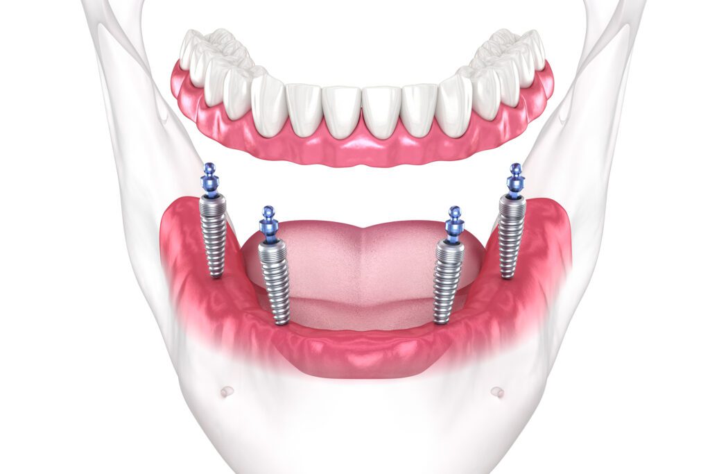 all on four implants in baltimore md