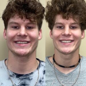 Prepless Veneers results