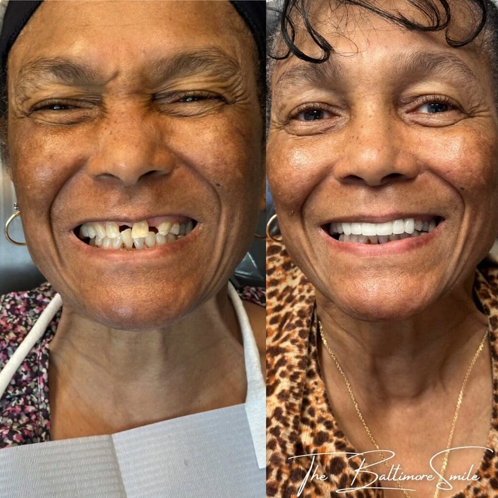 Happy patient before and after dental implants
