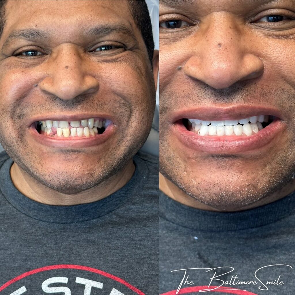 dental patient before and after restorative dentistry in Owings Mills, MD.