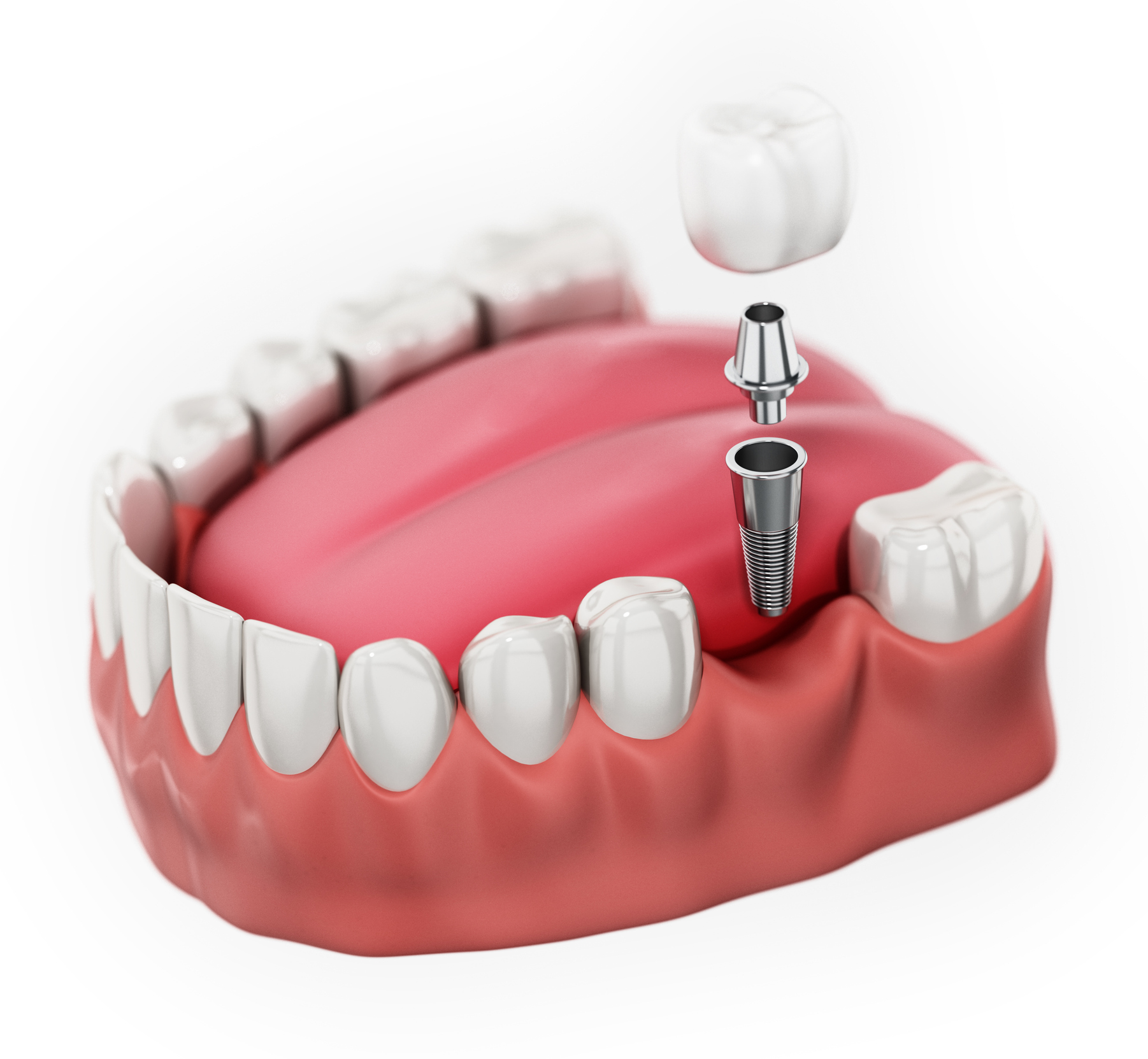 Single Tooth Dental Implant Baltimore MD | Missing Tooth