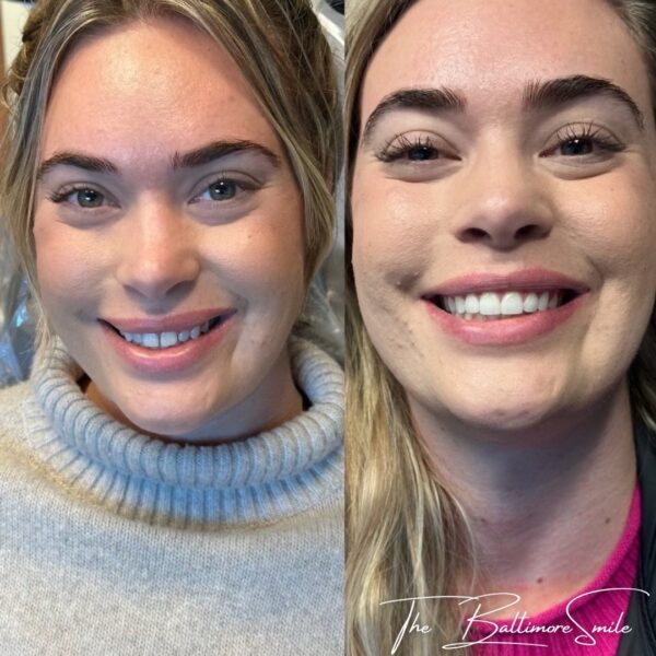 Prepless Veneers results