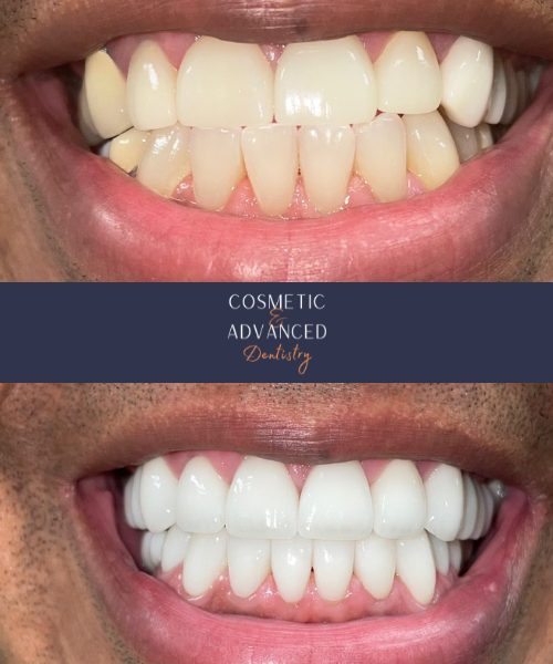 Dental patient before and after teeth whitening