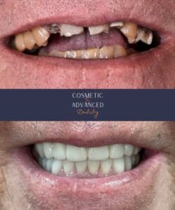 Dental patient before and after All-on-4 dental implants at Cosmetic & Advanced Dentistry