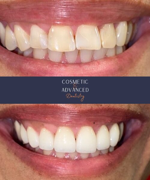 Dental patient before and after dental veneers