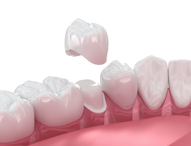 Dental Crowns in Towson, MD