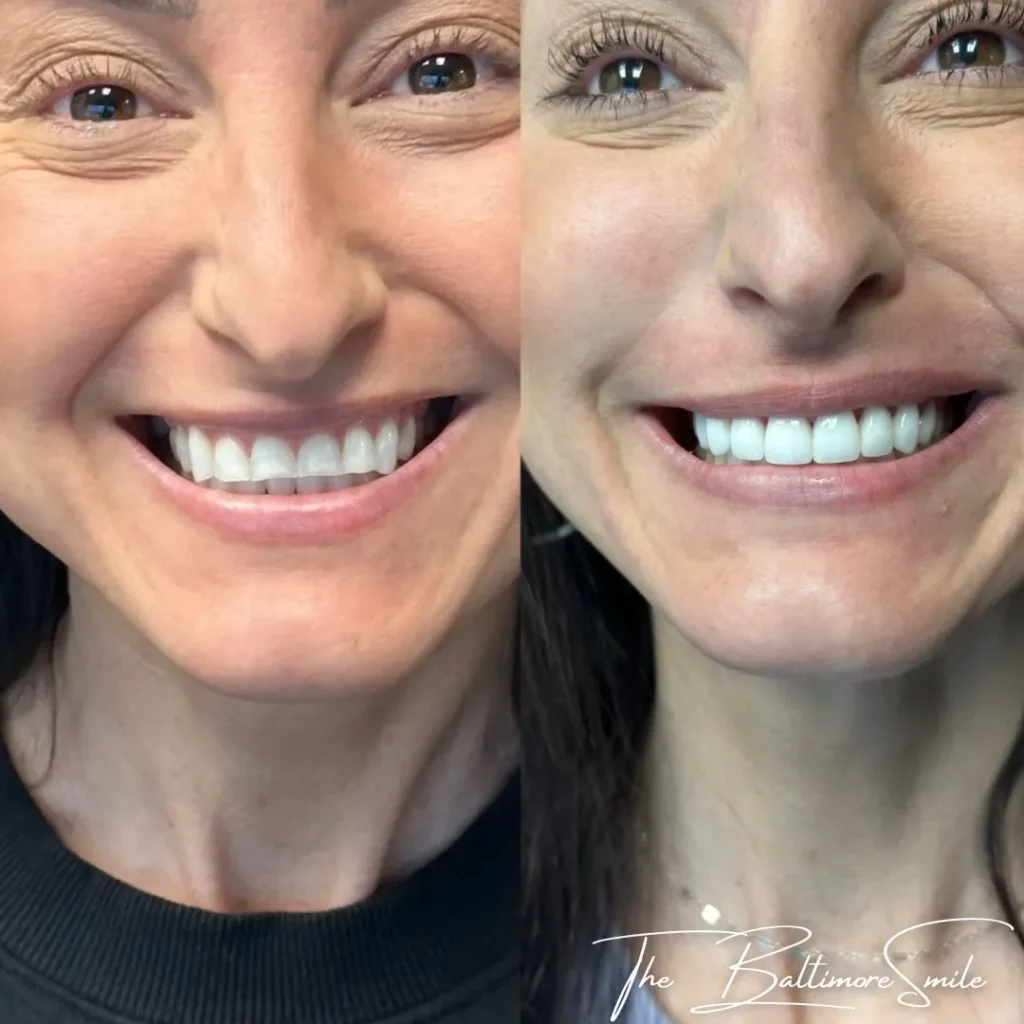 Before and after cosmetic dentistry at Cosmetic & Advanced Dentistry