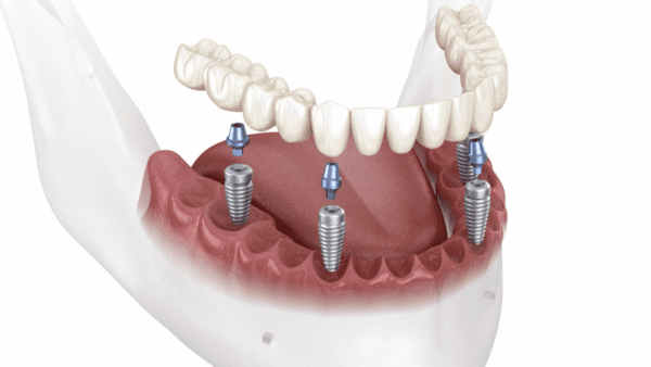 All On Four Implants in Baltimore MD