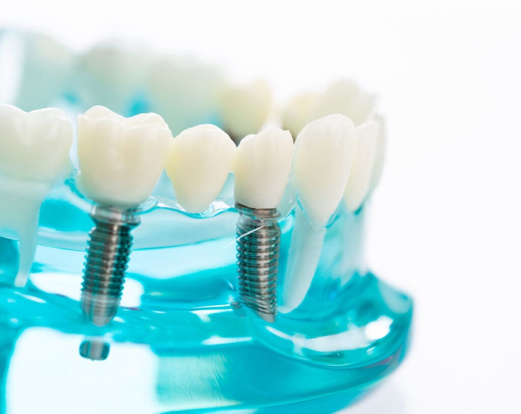 Same Day Implants Baltimore
