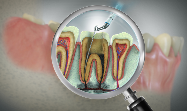 Apicoectomy procedure in Baltimore, MD