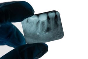 Root canal repair in Baltimore, MD